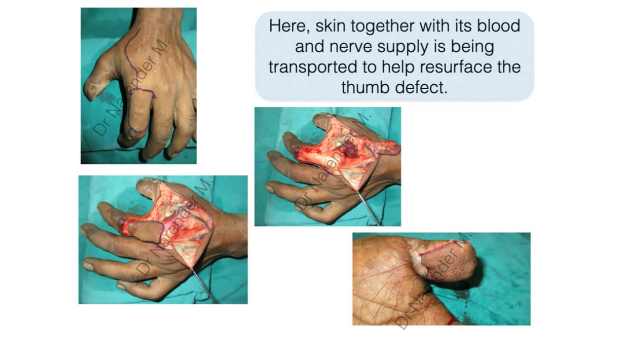 Hand Surgery Photo 14