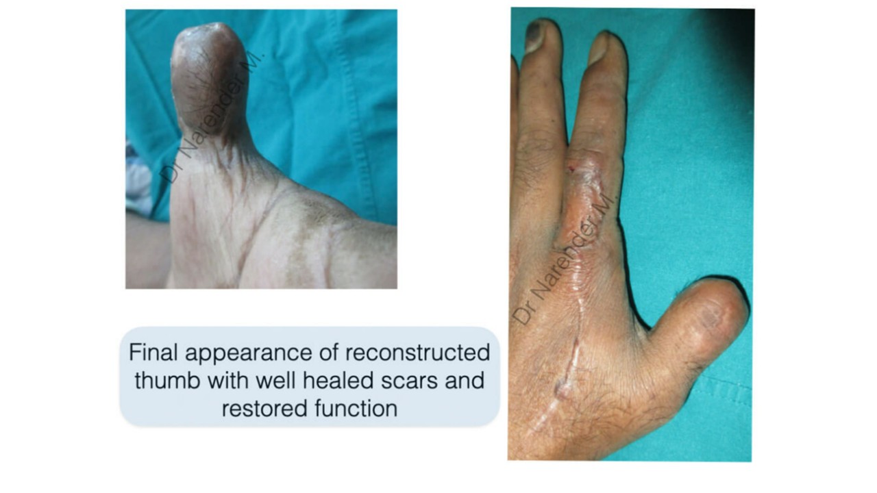 Hand Surgery Photo 15