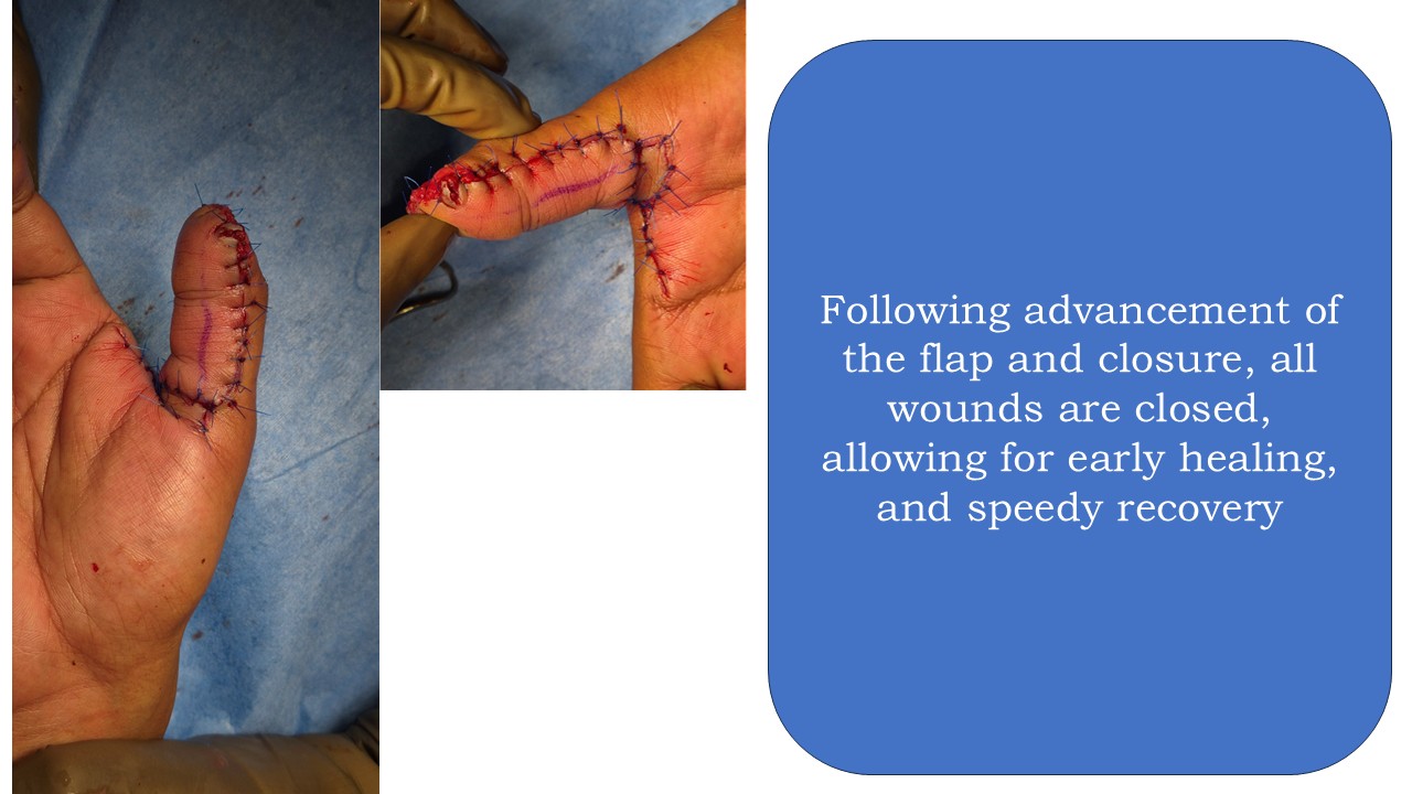 Hand Surgery Photo 2