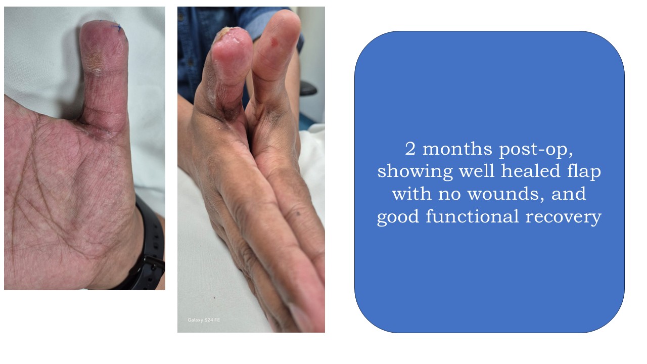 Hand Surgery Photo 3