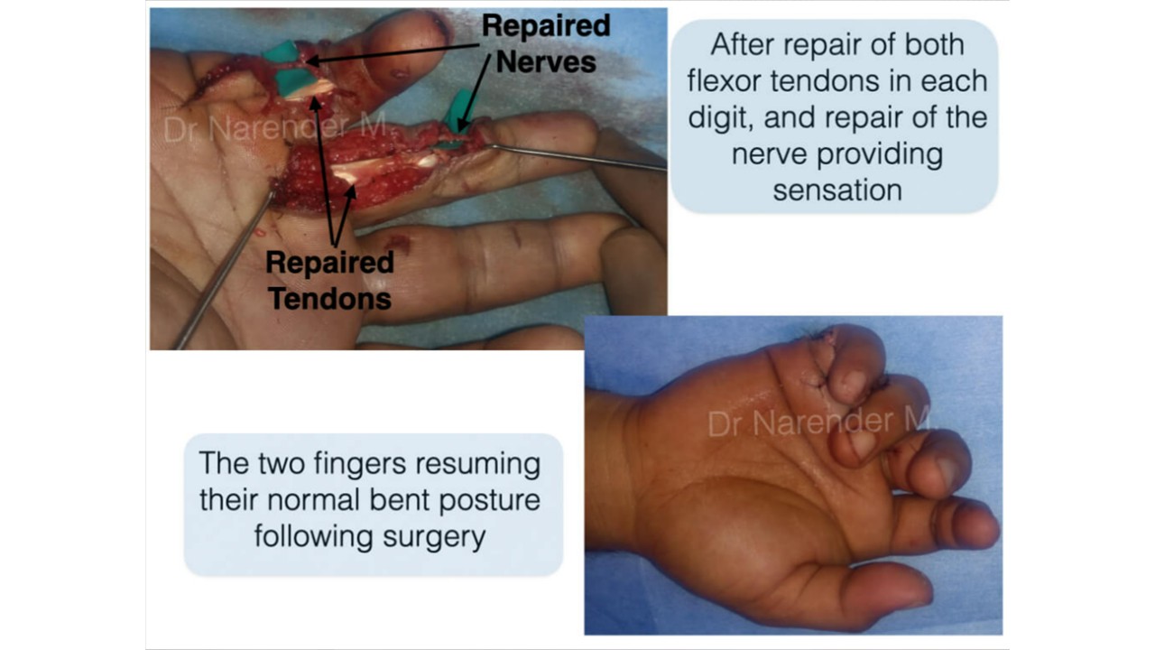 Hand Surgery Photo 5