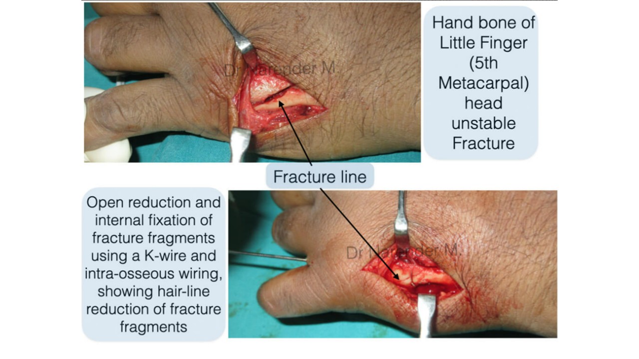Hand Surgery Photo 6