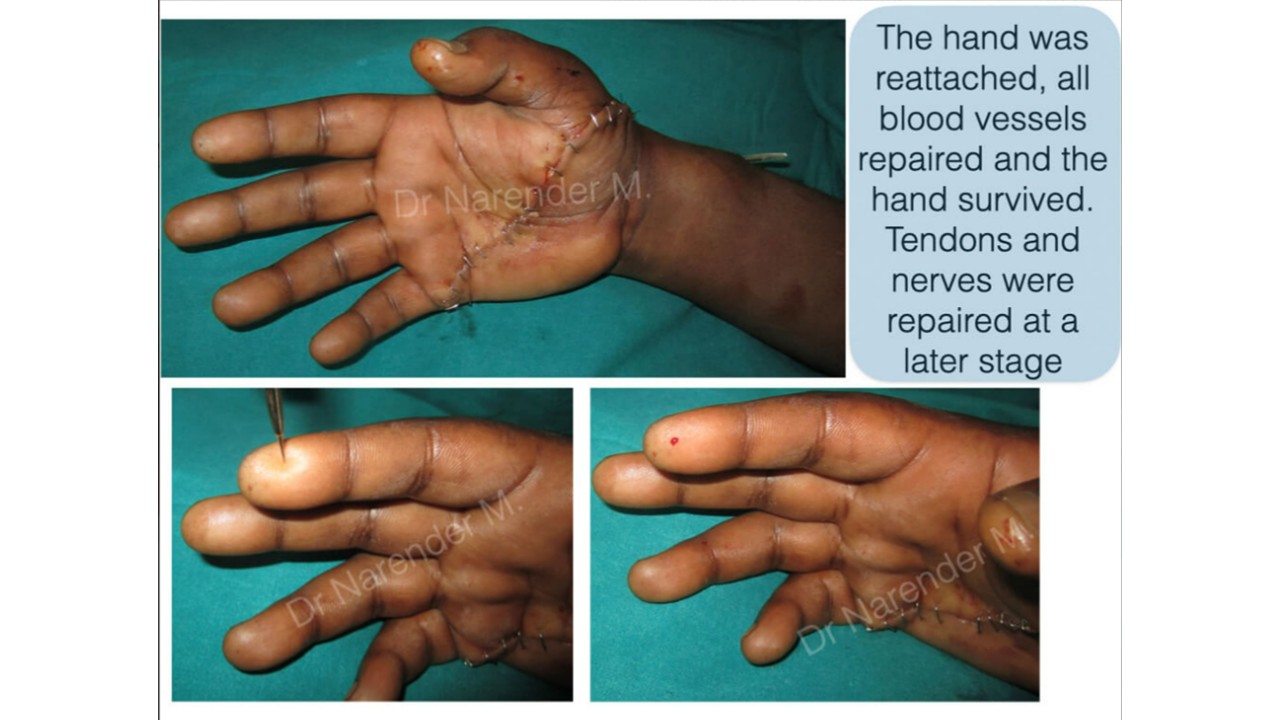 Hand Surgery Photo 8
