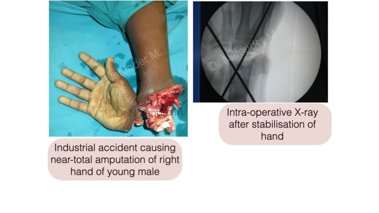 Hand Surgery Photo 9