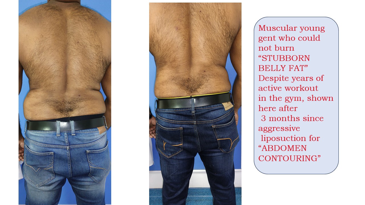 Liposuction Photo 10