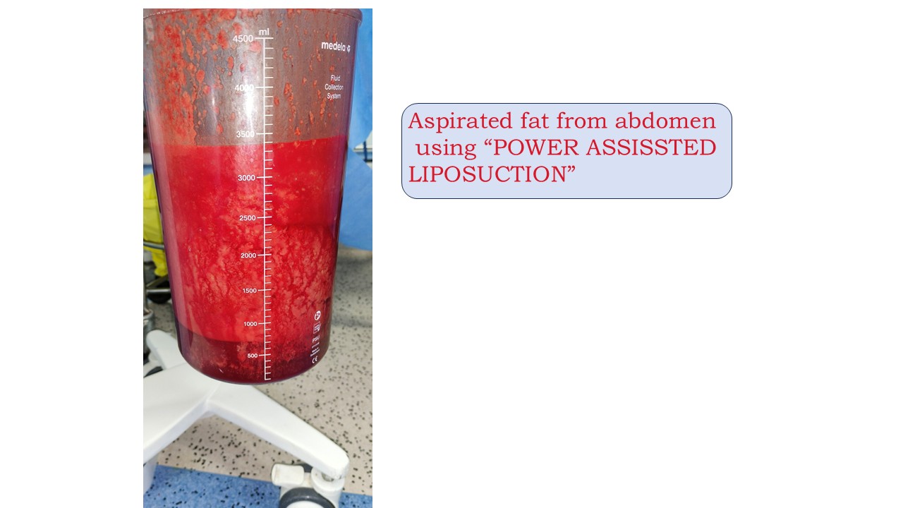 Liposuction Photo 11