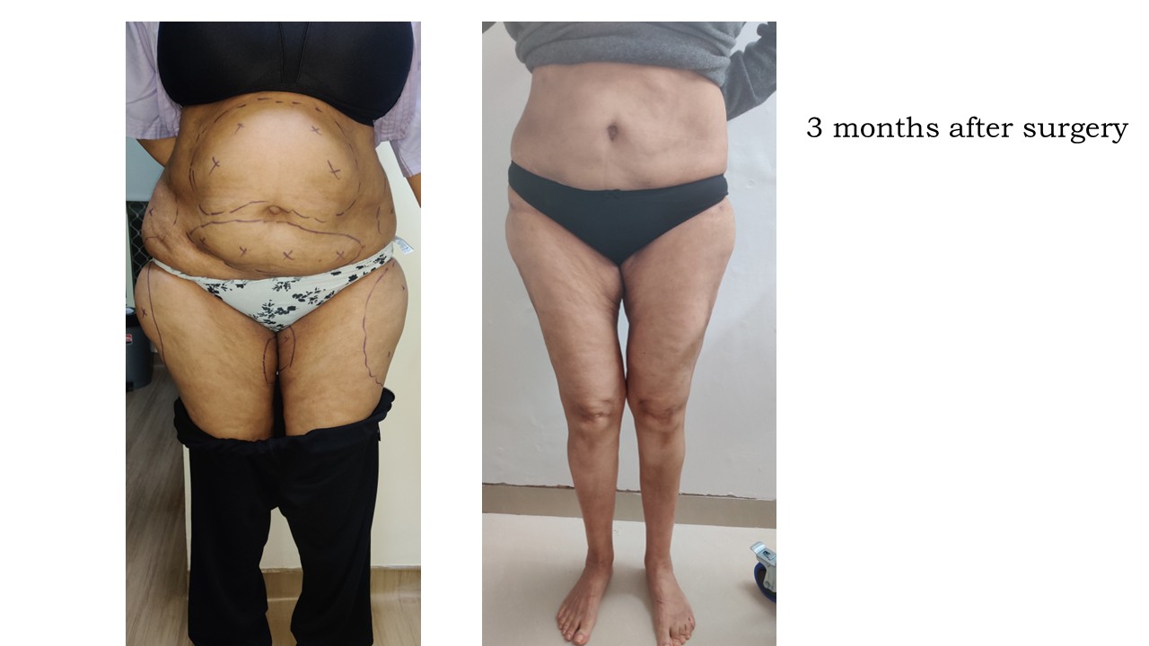 Liposuction Photo 1