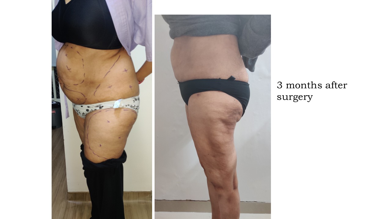 Liposuction Photo 2