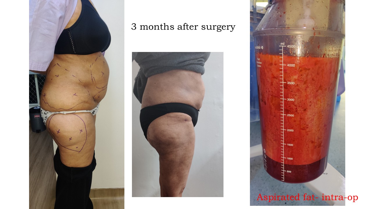 Liposuction Photo 3