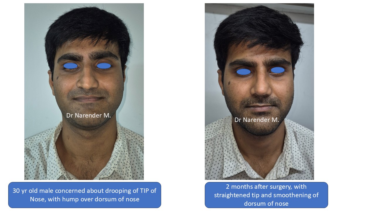 Rhinoplasty treatment image