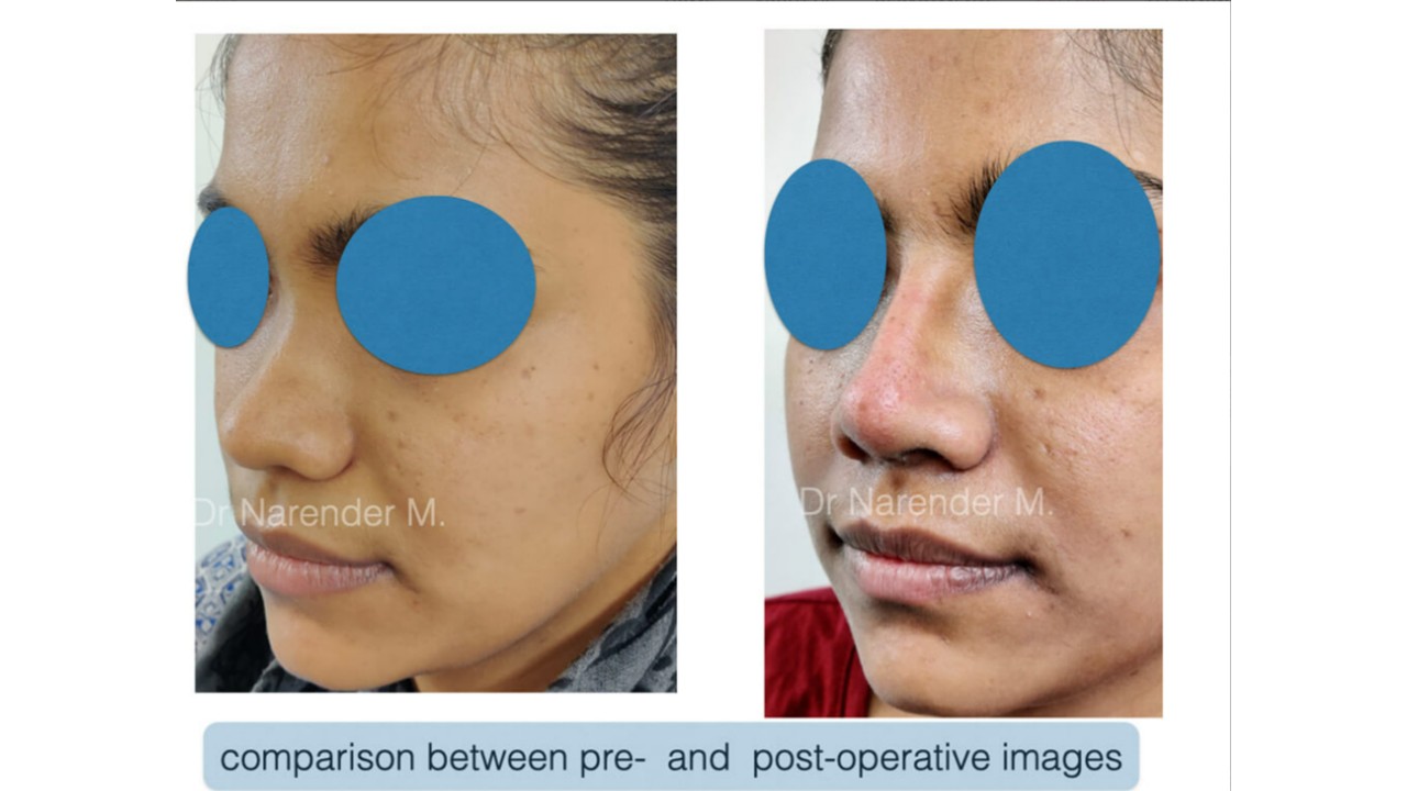 Rhinoplasty gallery image 10