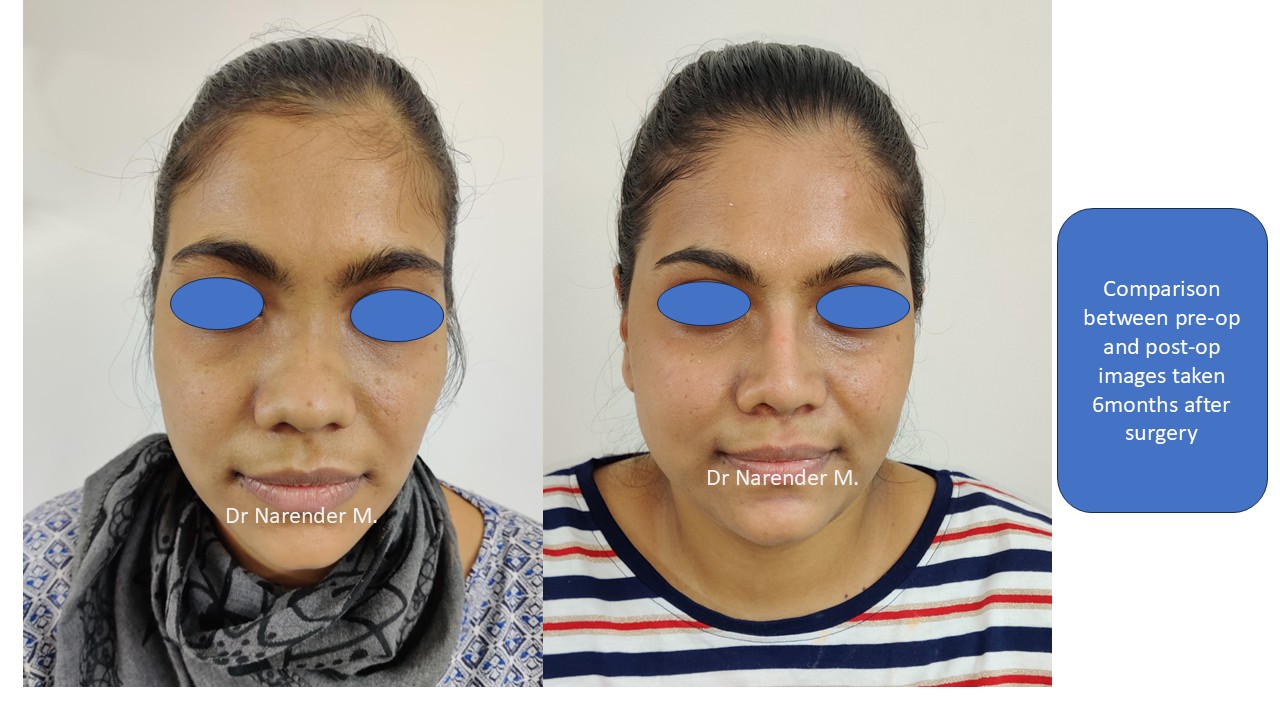 Rhinoplasty gallery image 11