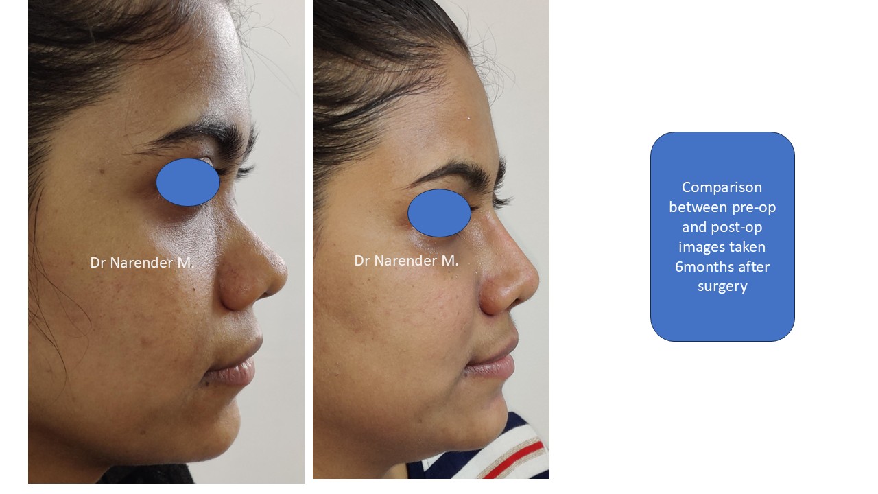 Rhinoplasty gallery image 12