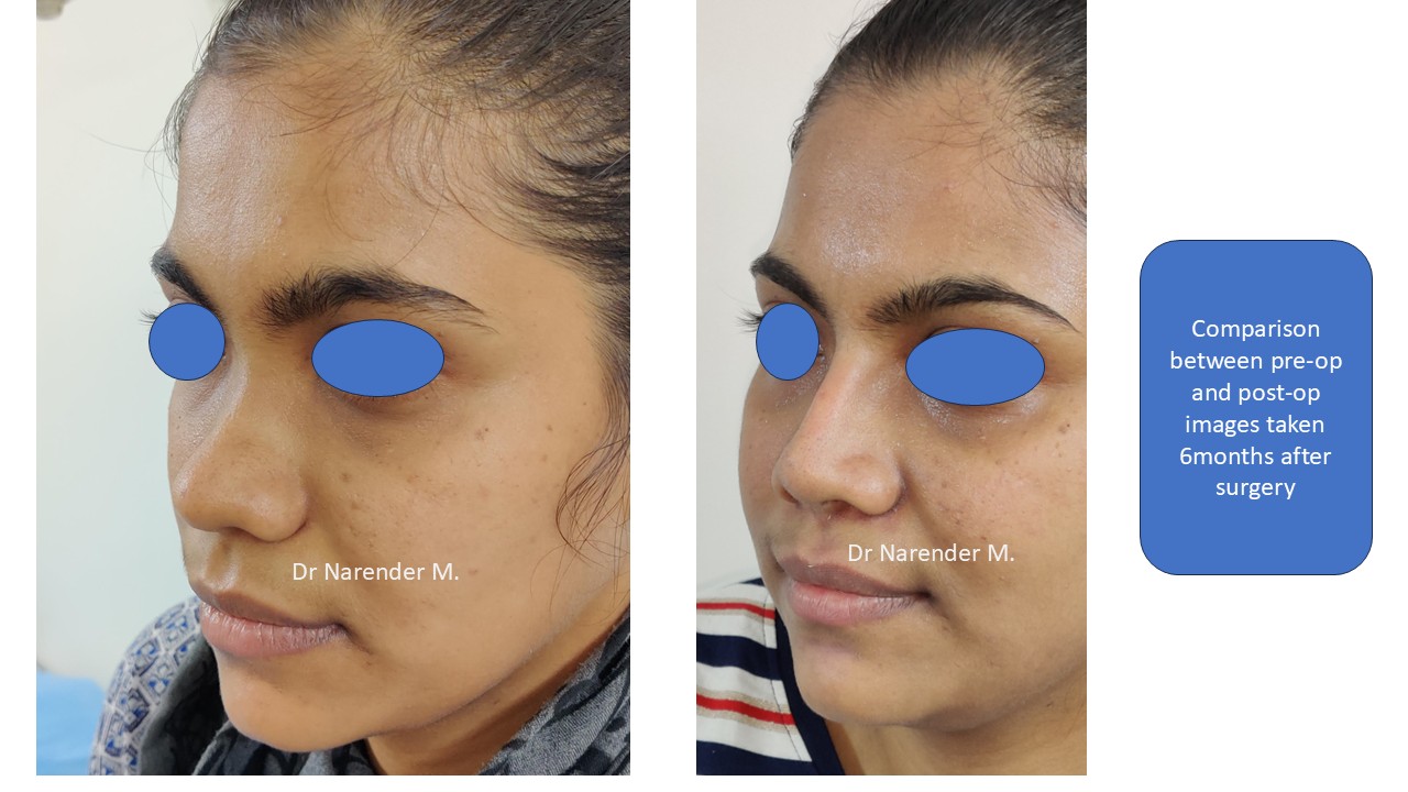 Rhinoplasty gallery image 13