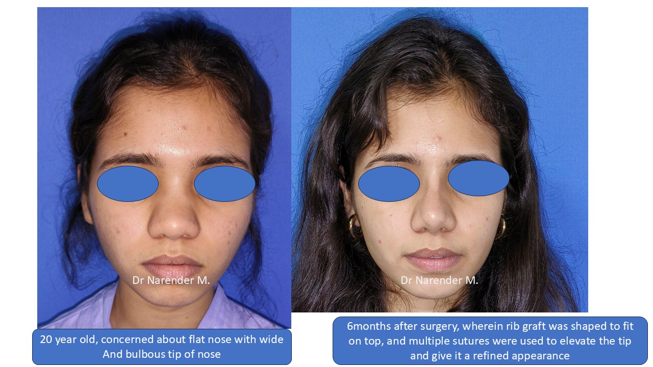 Rhinoplasty gallery image 14