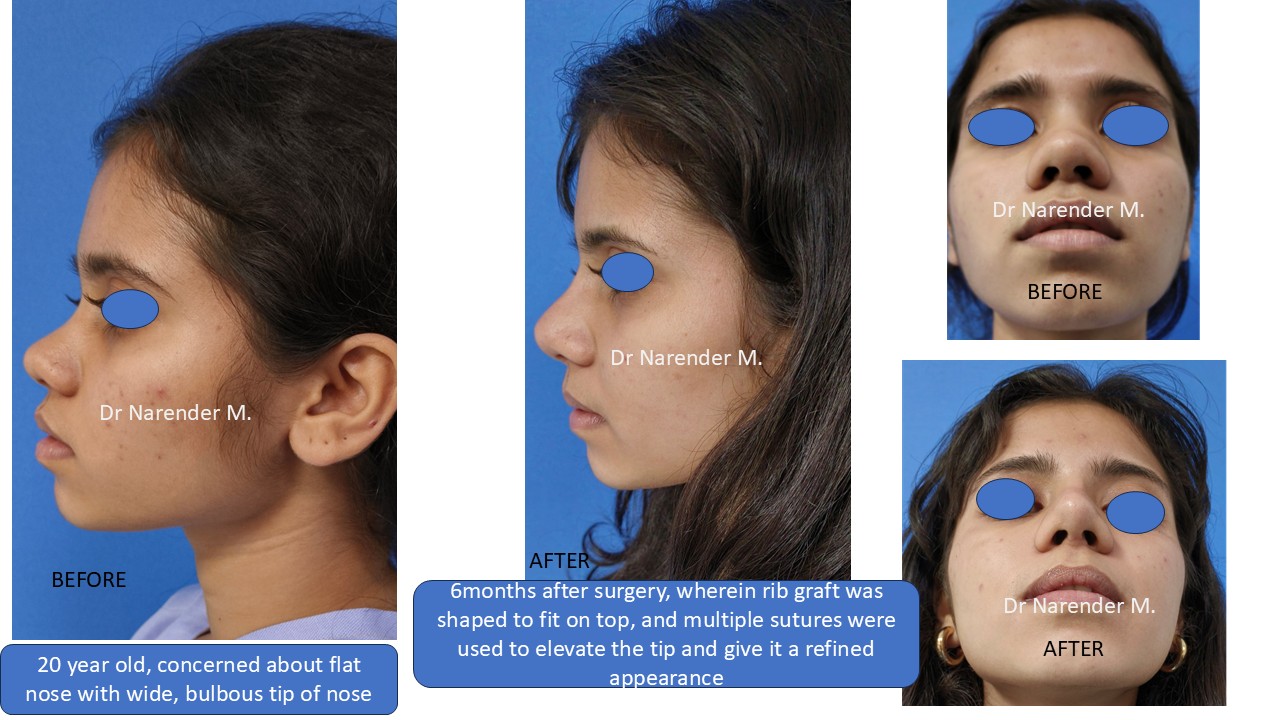 Rhinoplasty gallery image 15