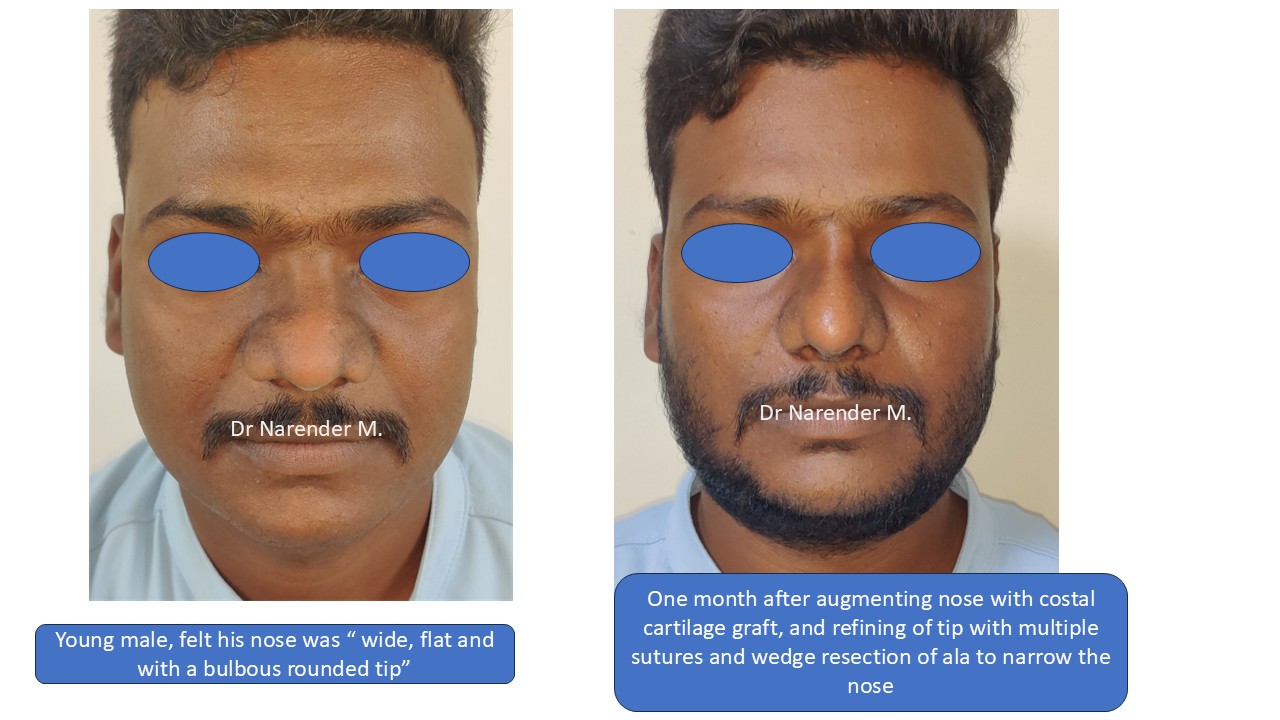 Rhinoplasty gallery image 16