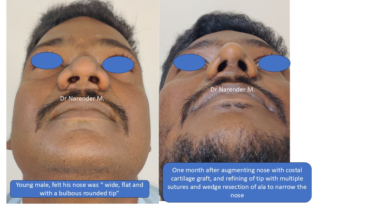 Rhinoplasty gallery image 17