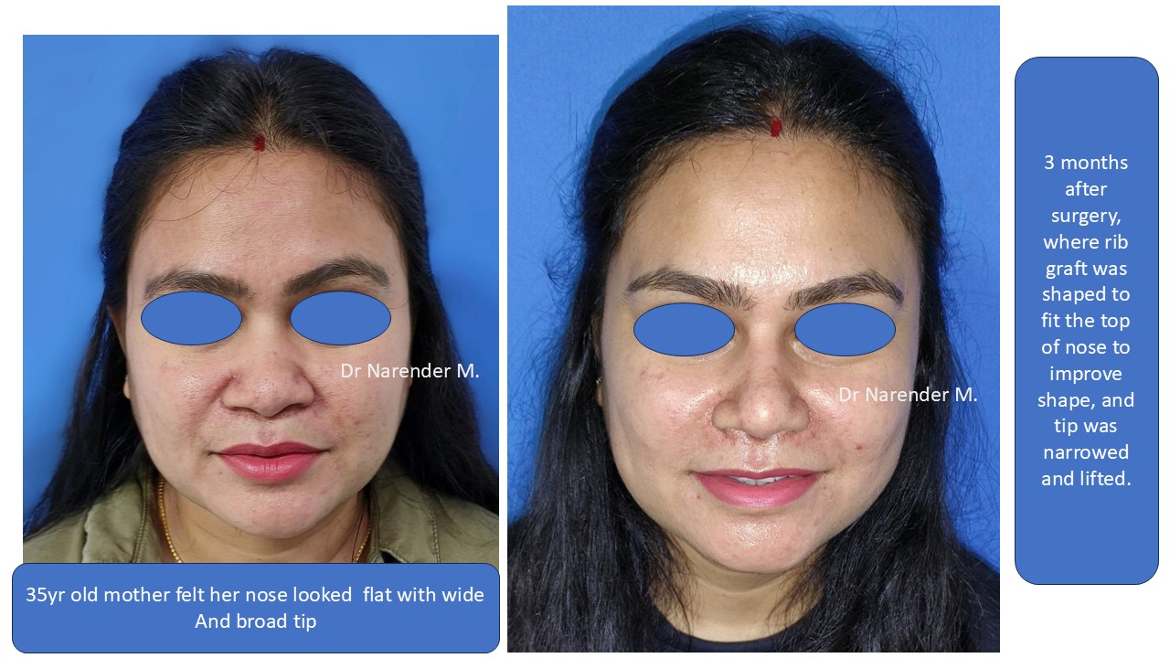 Rhinoplasty gallery image 19