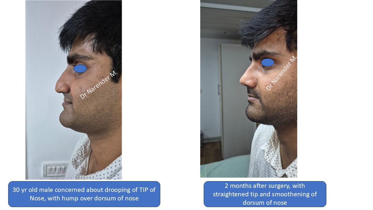 Rhinoplasty gallery image 2
