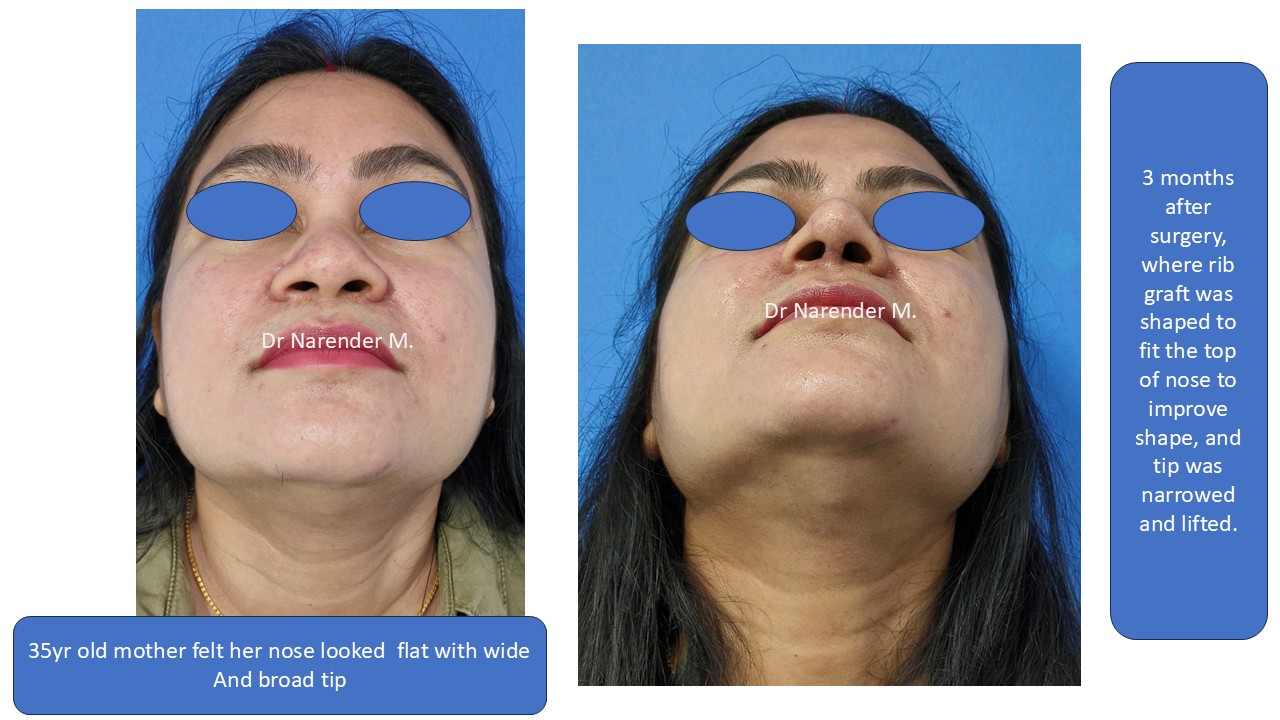 Rhinoplasty gallery image 20