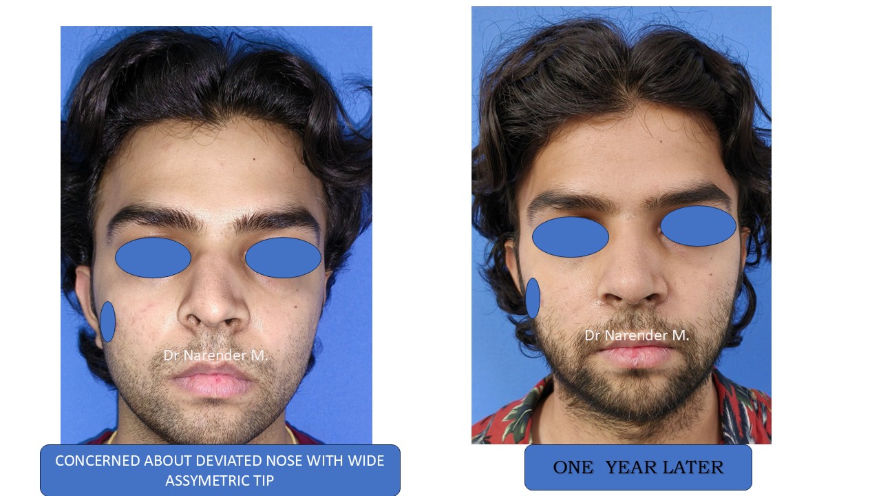 Rhinoplasty gallery image 21