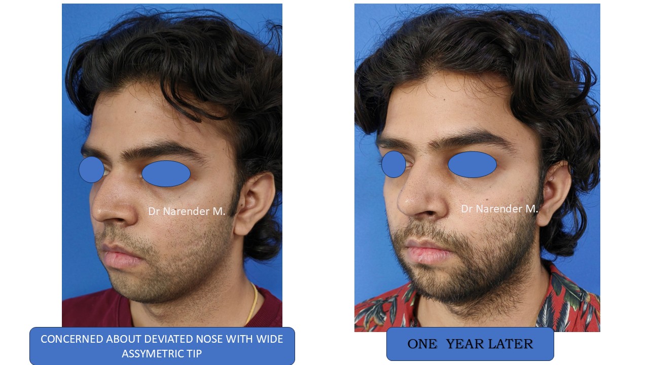 Rhinoplasty gallery image 22