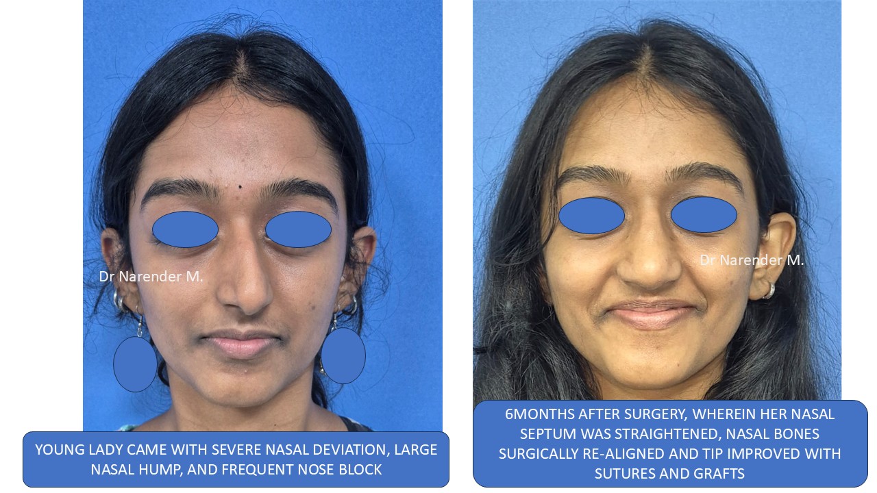 Rhinoplasty gallery image 23