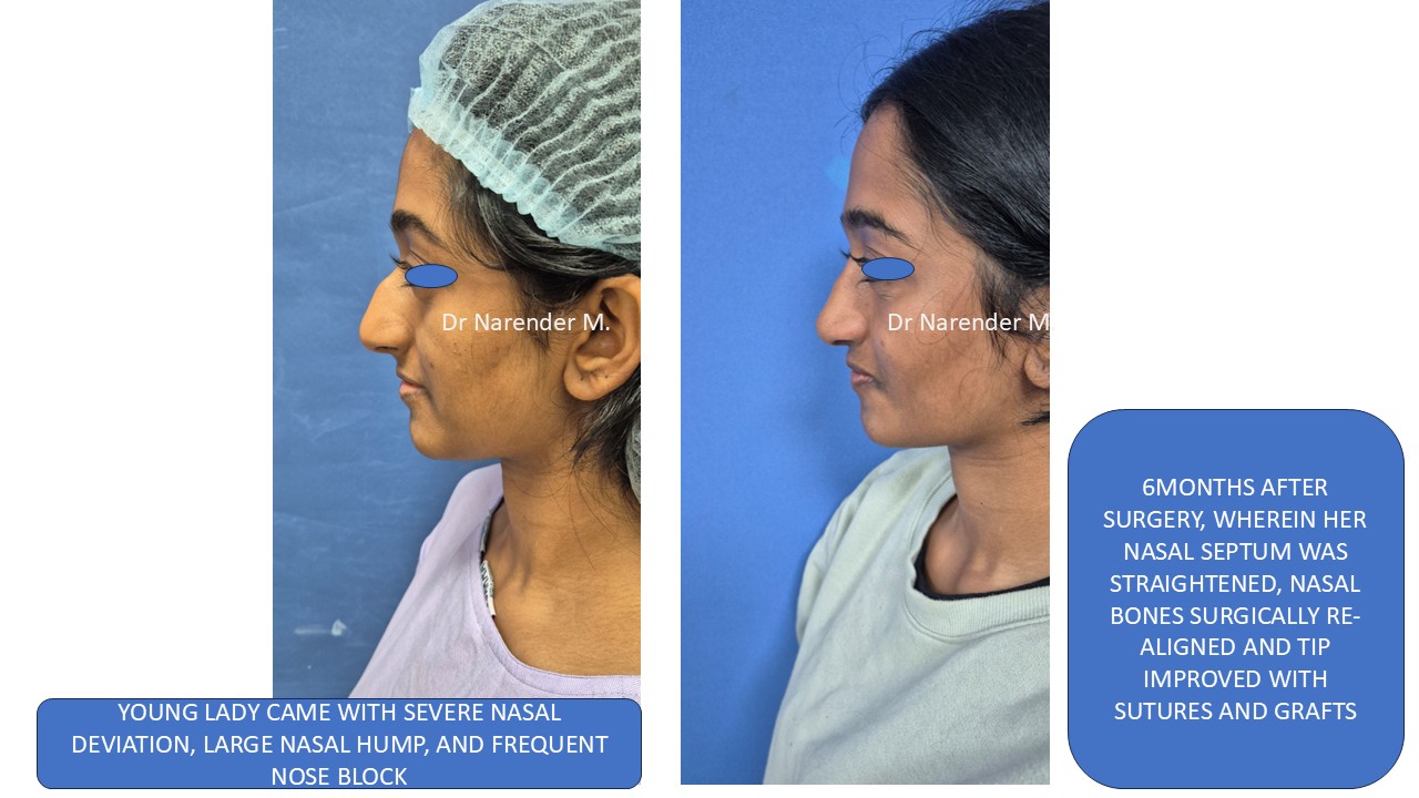Rhinoplasty gallery image 24