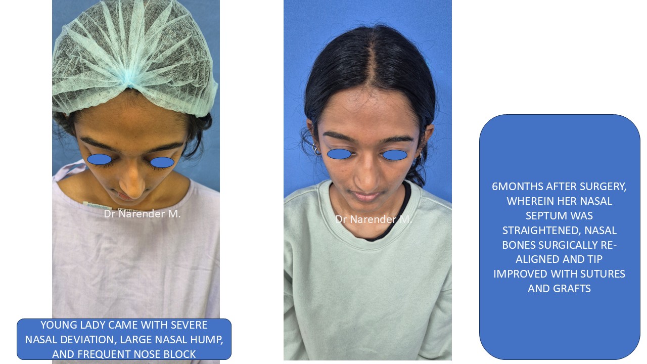Rhinoplasty gallery image 25