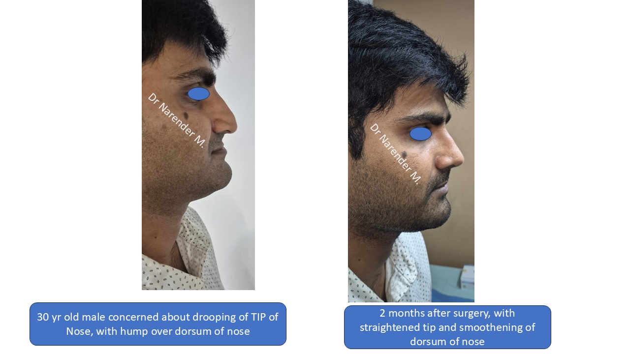 Rhinoplasty gallery image 3