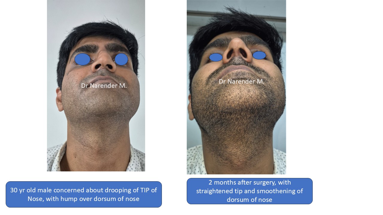 Rhinoplasty gallery image 4