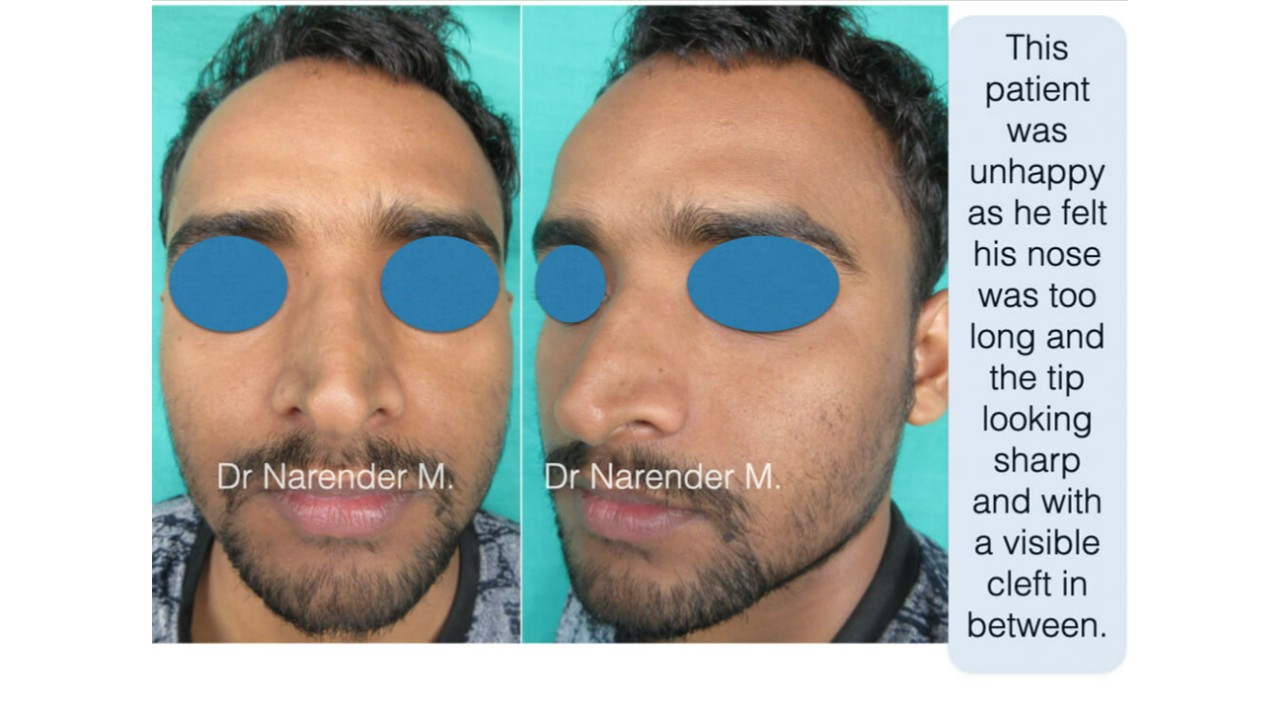 Rhinoplasty gallery image 5