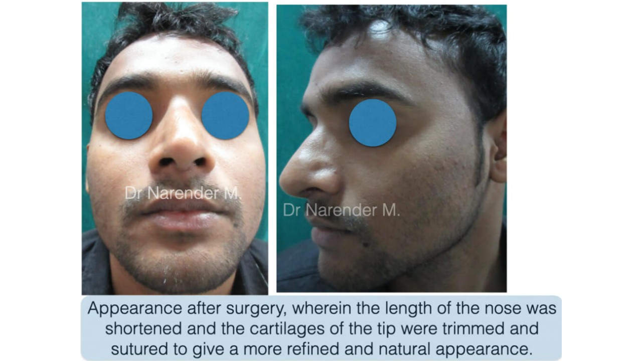 Rhinoplasty gallery image 6