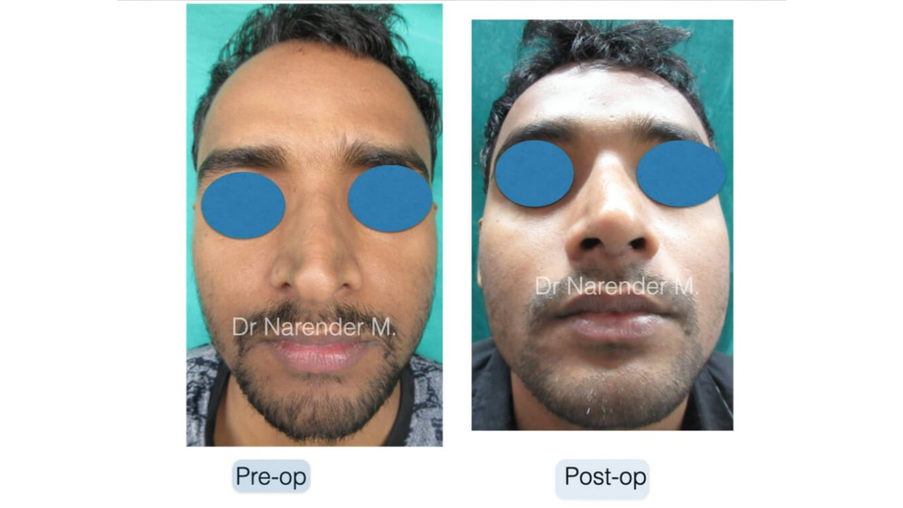 Rhinoplasty gallery image 7