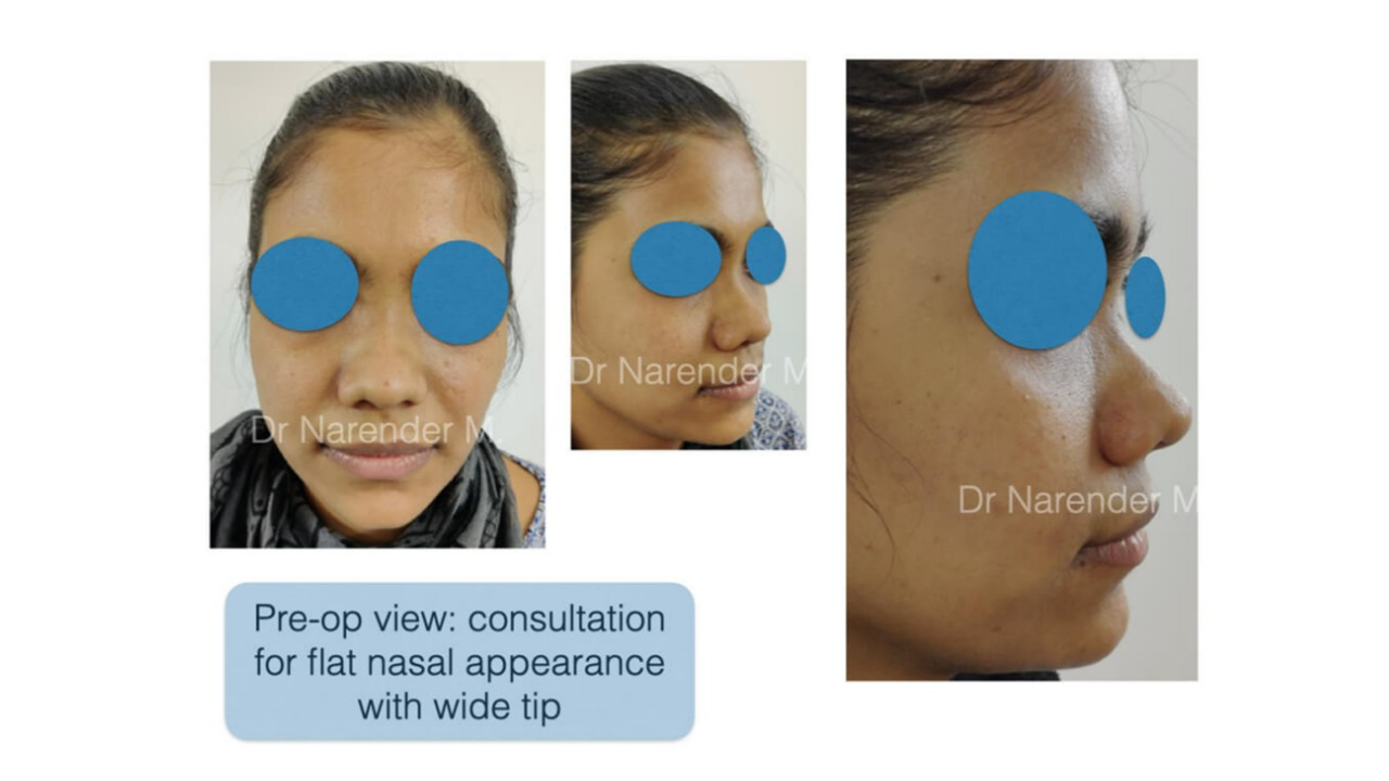 Rhinoplasty gallery image 8