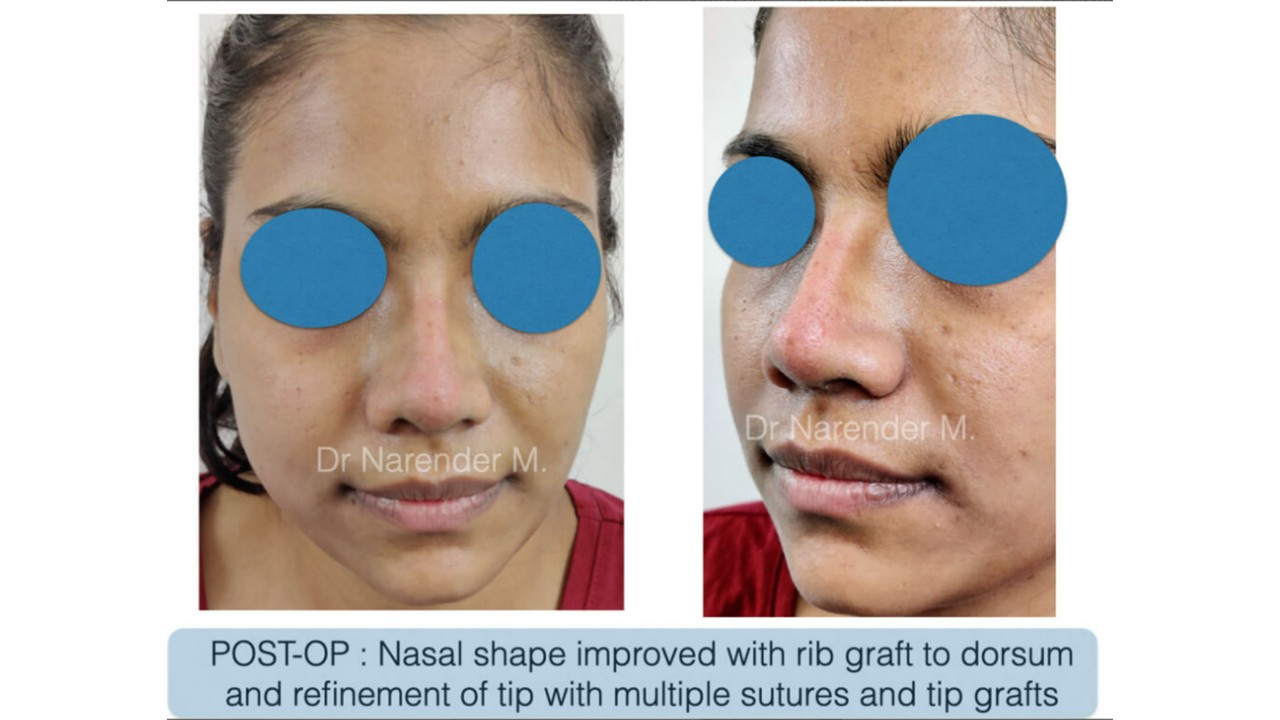 Rhinoplasty gallery image 9