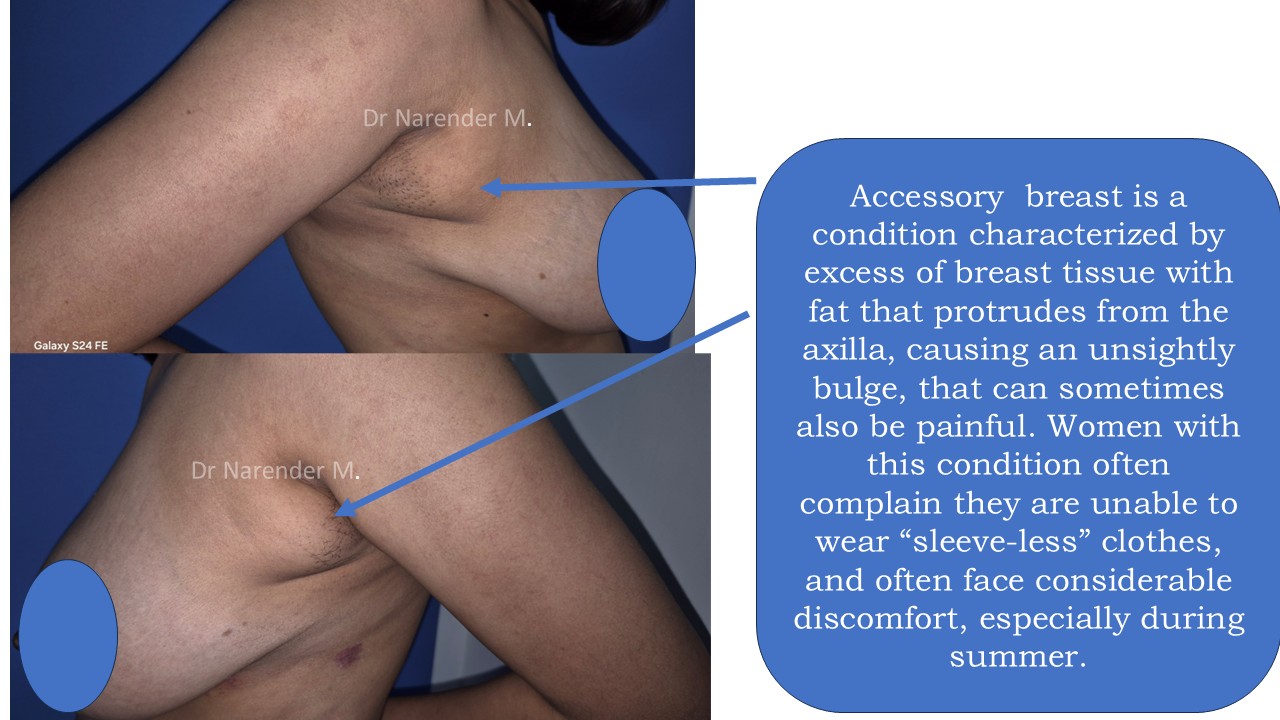 Accessory Breast Removal