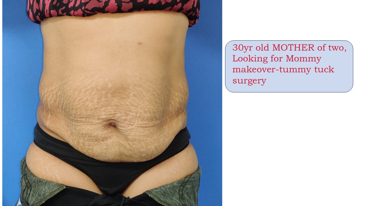 Tummy Tuck Photo 1