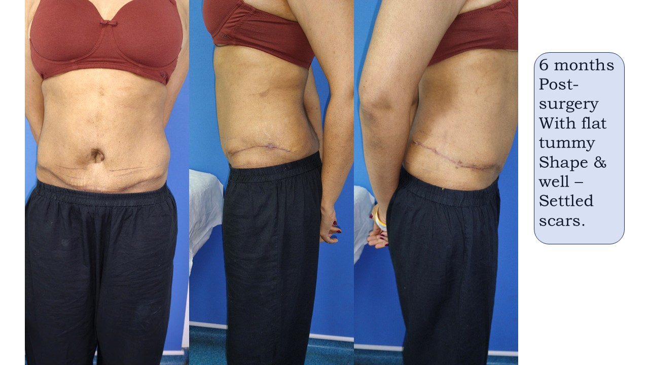 Tummy Tuck Photo 10