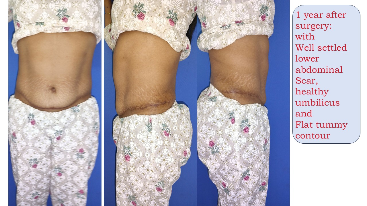 Tummy Tuck Photo 4