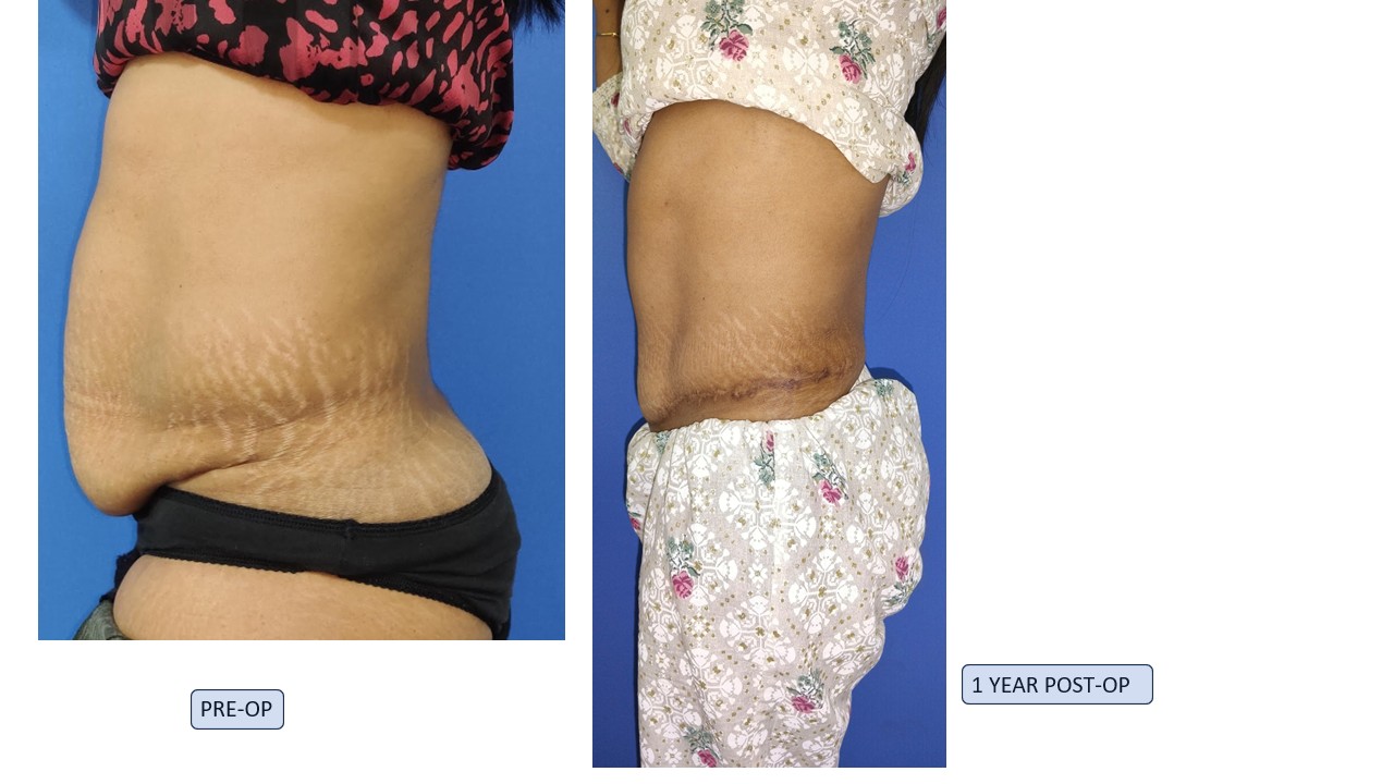 Tummy Tuck Photo 6