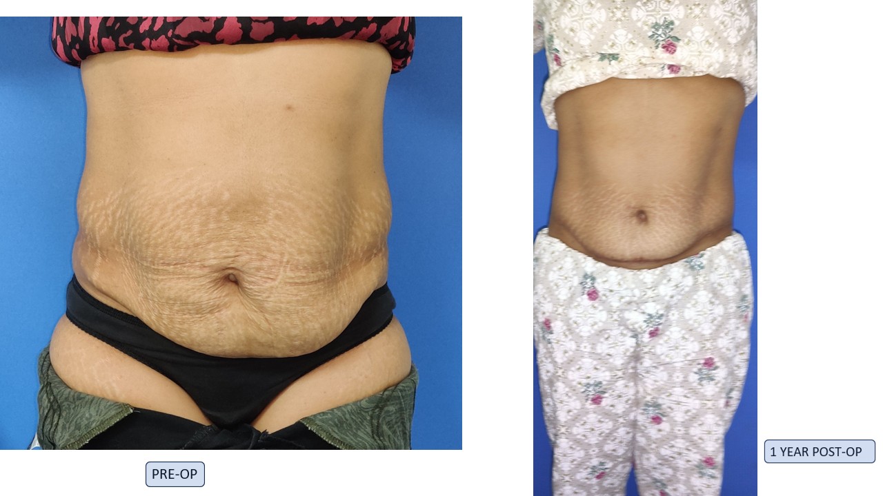 Tummy Tuck Photo 7