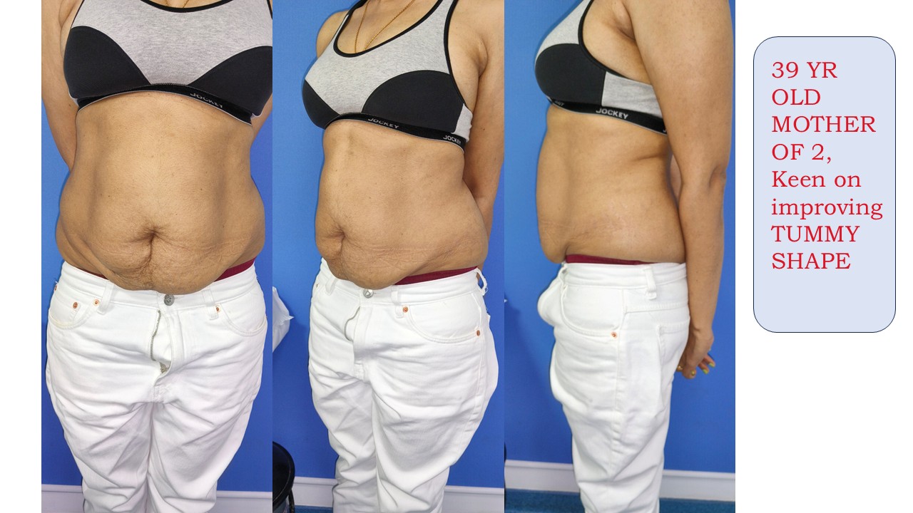 Tummy Tuck Photo 8