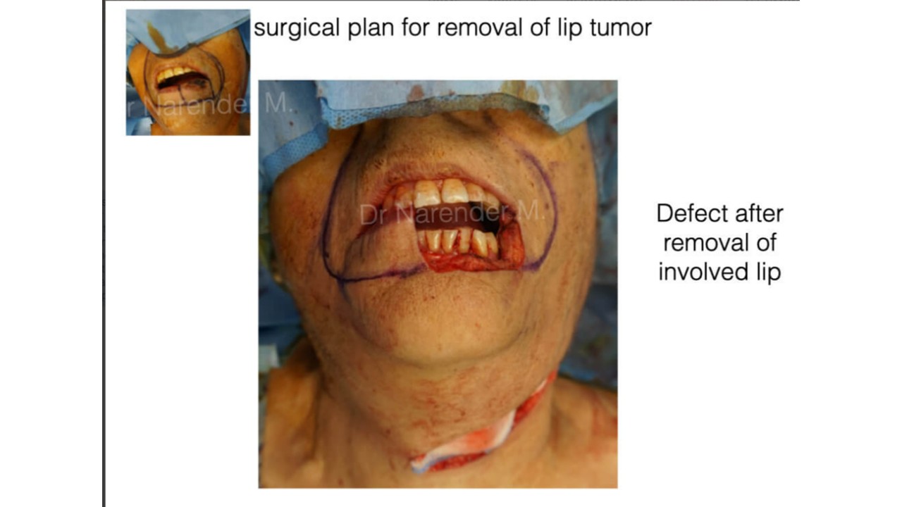 Cancer Reconstruction Photo 1