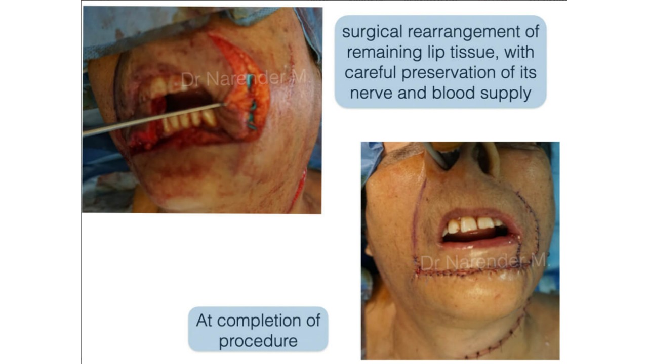 Cancer Reconstruction Photo 2