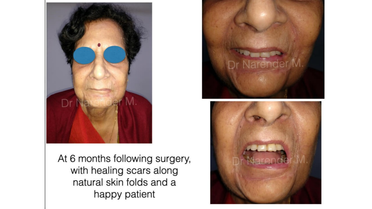Cancer Reconstruction Photo 3
