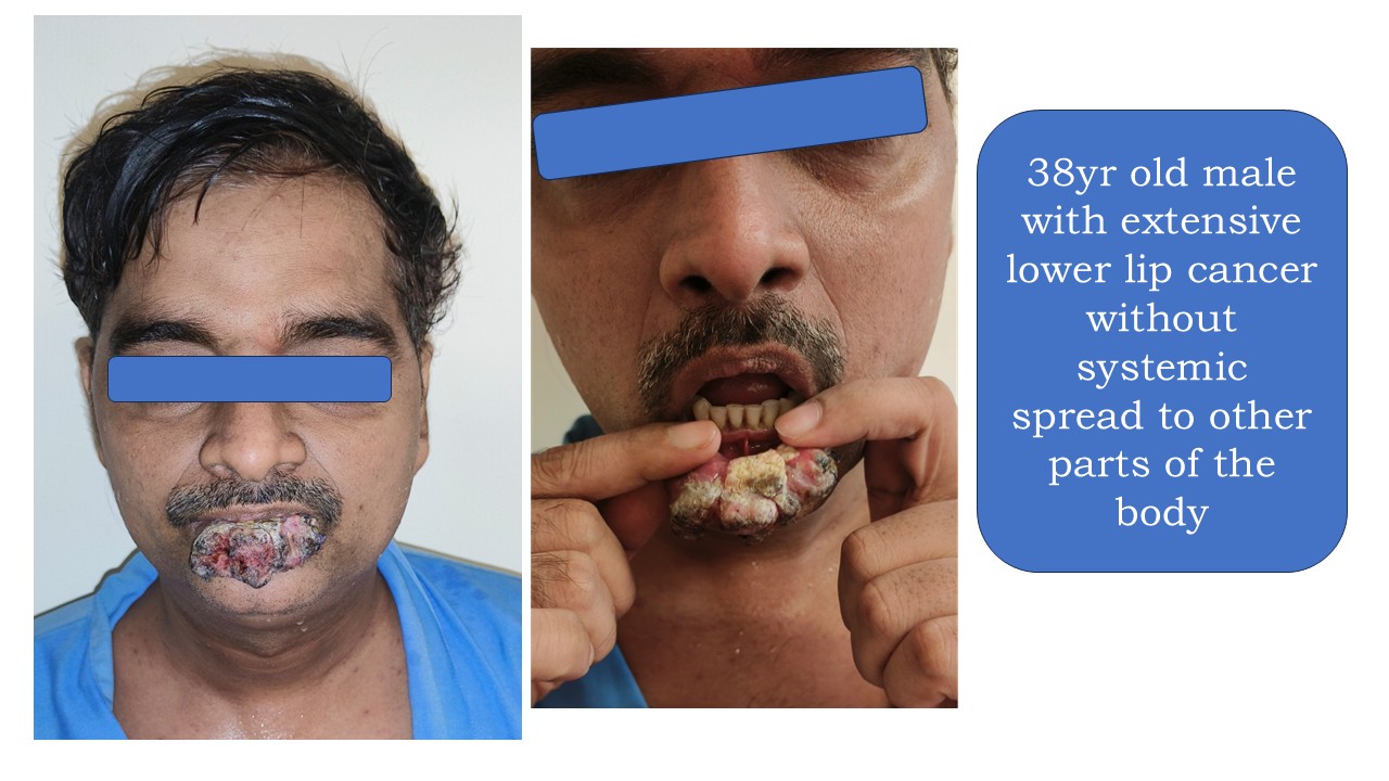 Cancer Reconstruction Photo 4