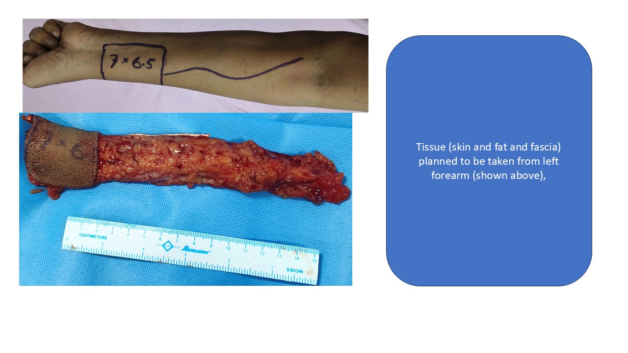 Cancer Reconstruction Photo 5