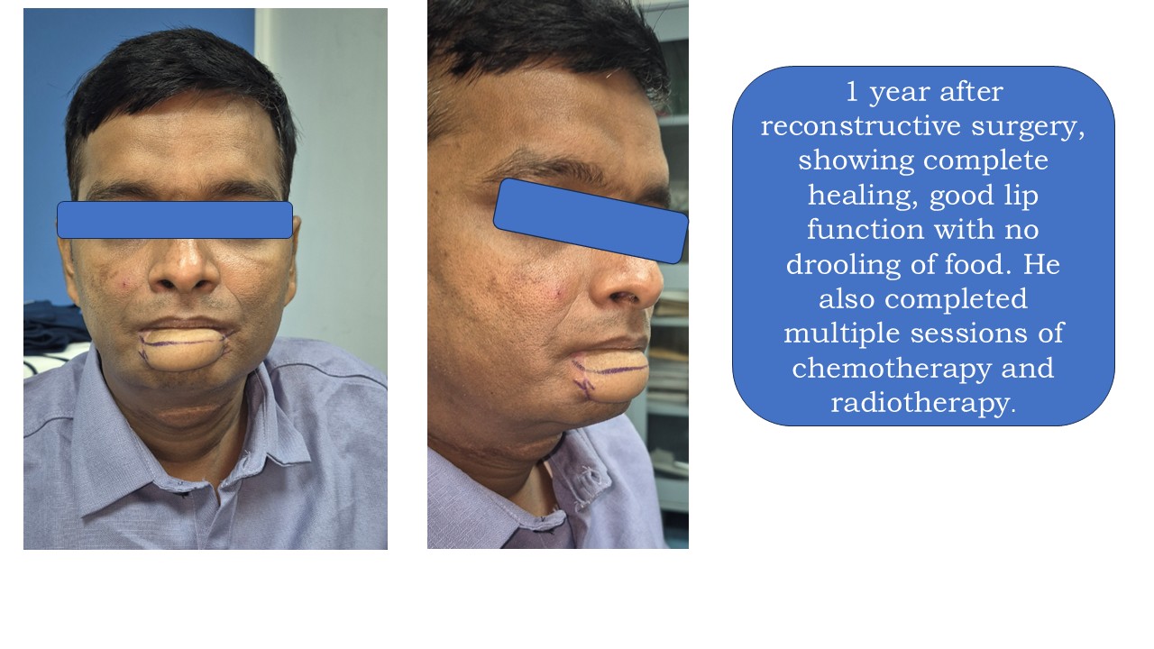 Cancer Reconstruction Photo 6